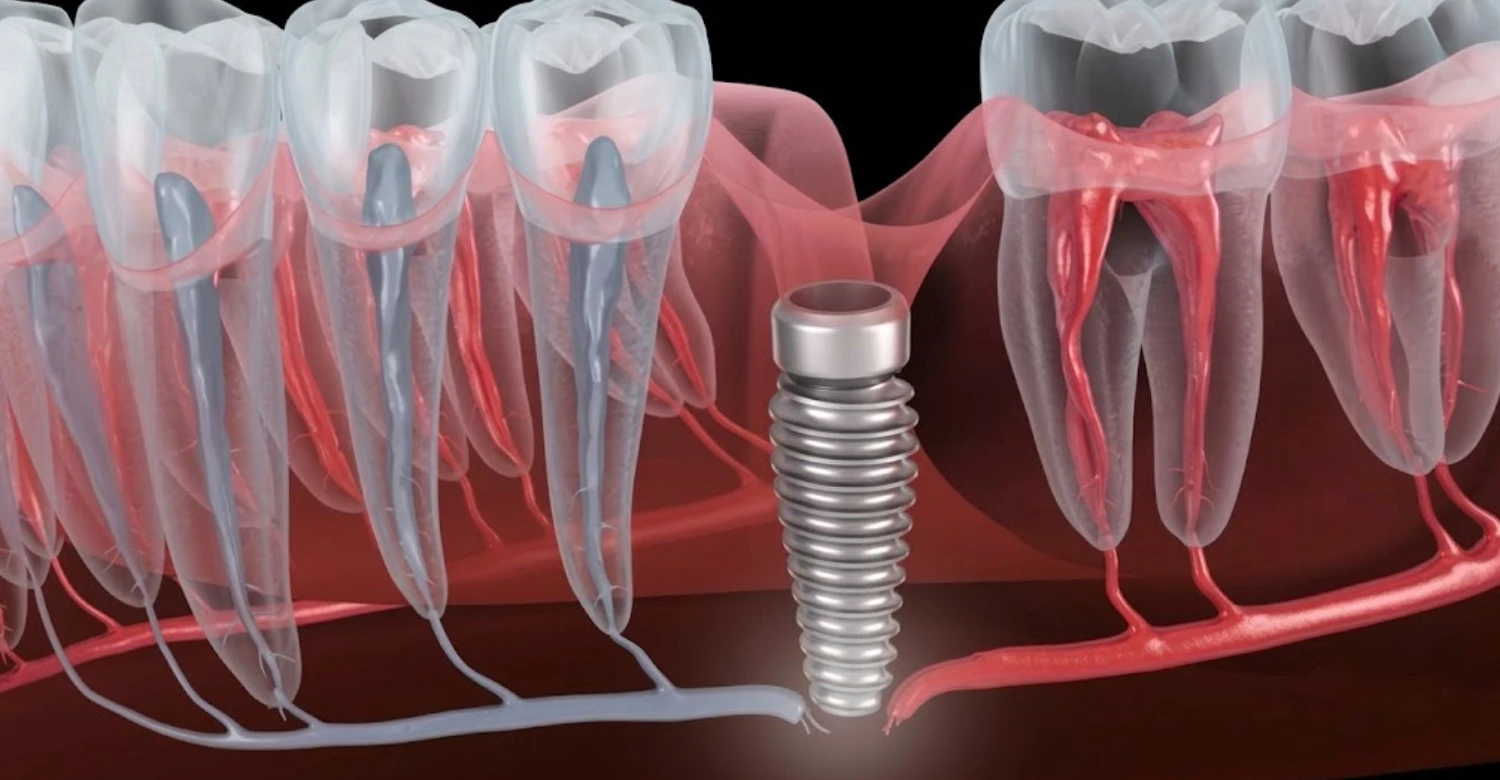 Dental Implant Nerve Damage inblog